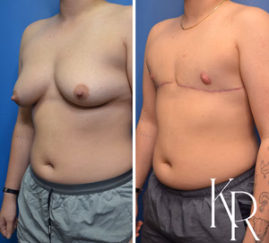 Top surgery before and after photo, oblique view
