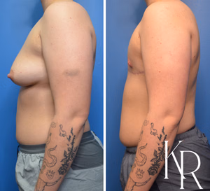 Top surgery before and after photo, side view