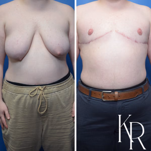 Top surgery before and after photo, front view