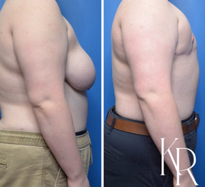 Top surgery before and after photo, side view