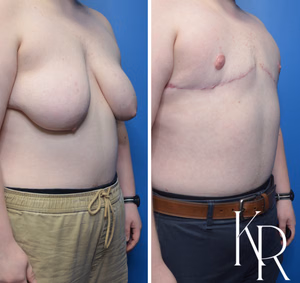 Top surgery before and after photo, front view