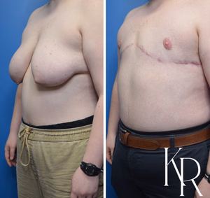 Top surgery before and after photo, oblique view