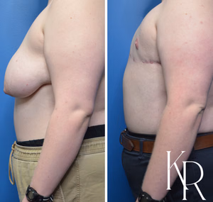 Top surgery before and after photo, side view