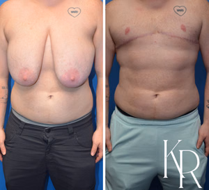 Top surgery before and after photo, front view