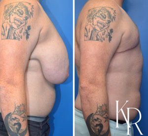 Top surgery before and after photo, side view