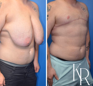 Top surgery before and after photo, front view