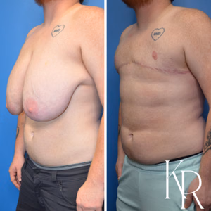 Top surgery before and after photo, oblique view
