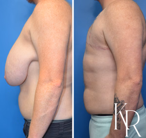 Top surgery before and after photo, side view