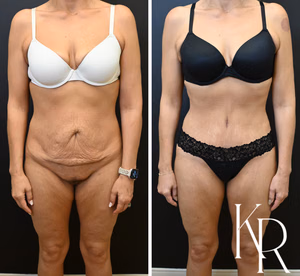 Tummy tuck before and after photo, front view