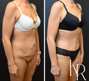 Tummy tuck before and after photo, front view
