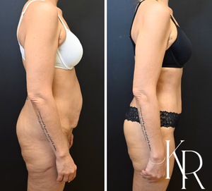 Tummy tuck before and after photo, side view