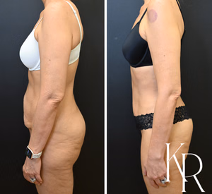 Tummy tuck before and after photo, side view