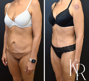Tummy tuck before and after photo, oblique view