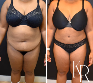 Tummy tuck before and after photo, front view