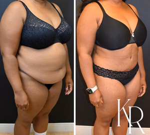 Tummy tuck before and after photo, front view