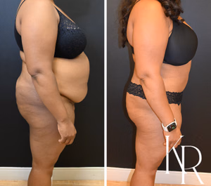 Tummy tuck before and after photo, side view
