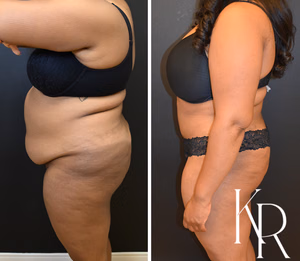 Tummy tuck before and after photo, side view
