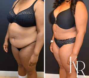 Tummy tuck before and after photo, oblique view