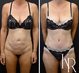 Tummy tuck before and after photo, front view