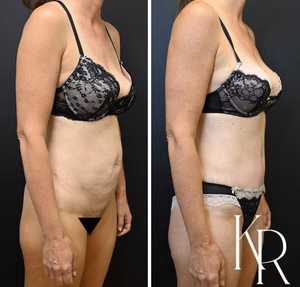 Tummy tuck before and after photo, front view