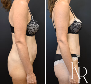 Tummy tuck before and after photo, side view