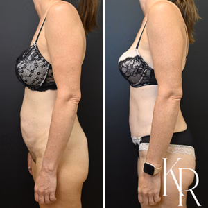 Tummy tuck before and after photo, side view