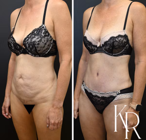 Tummy tuck before and after photo, oblique view