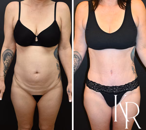 Tummy tuck before and after photo, front view