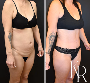 Tummy tuck before and after photo, front view