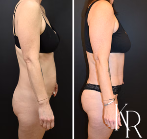Tummy tuck before and after photo, side view