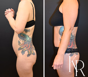 Tummy tuck before and after photo, side view