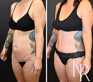 Tummy tuck before and after photo, oblique view