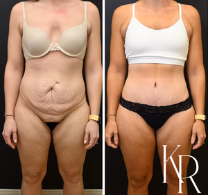 Tummy tuck before and after photo, front view