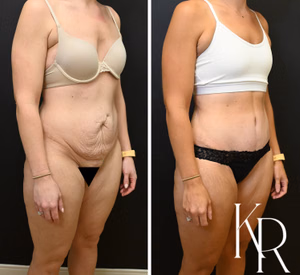 Tummy tuck before and after photo, front view