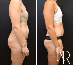 Tummy tuck before and after photo, side view
