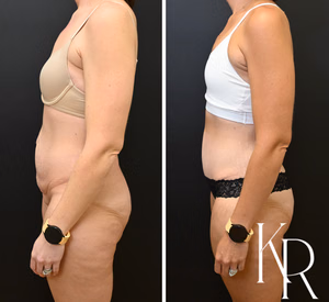 Tummy tuck before and after photo, side view