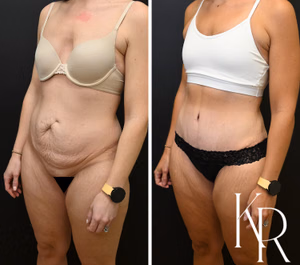 Tummy tuck before and after photo, oblique view