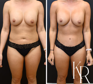 Tummy tuck before and after photo, front view