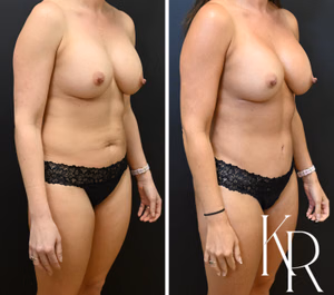 Tummy tuck before and after photo, front view