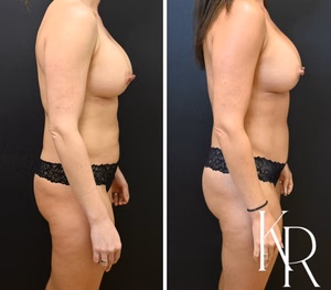 Tummy tuck before and after photo, side view