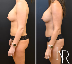 Tummy tuck before and after photo, side view