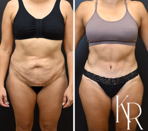 Tummy tuck before and after photo, front view