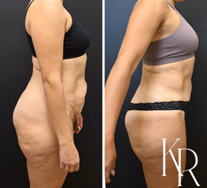 Tummy tuck before and after photo, side view