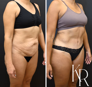 Tummy tuck before and after photo, front view