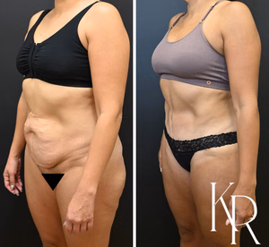 Tummy tuck before and after photo, oblique view
