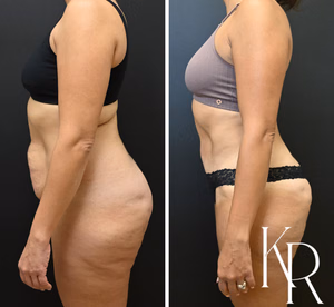 Tummy tuck before and after photo, side view