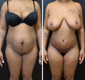 Tummy tuck before and after photo, front view