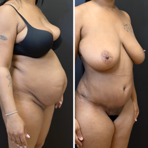 Tummy tuck before and after photo, oblique view