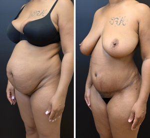 Tummy tuck before and after photo, oblique view