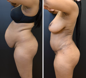 Tummy tuck before and after photo, side view